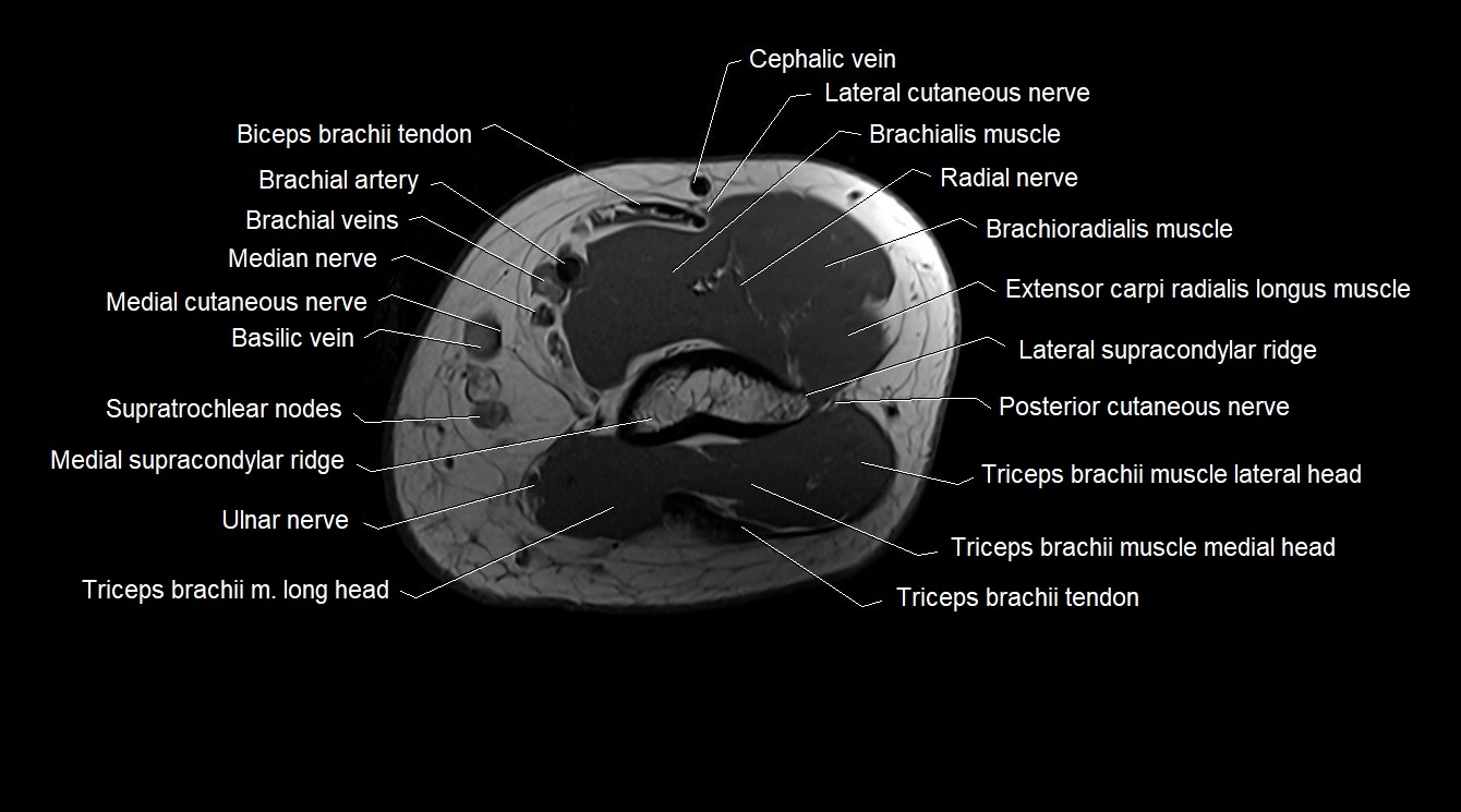 Upper arm( humerus) cross section anatomy MRI 3T axial image 50.webp